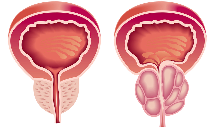 a prosztata adenoma gyulladása mi a prostatis milyen kezelés