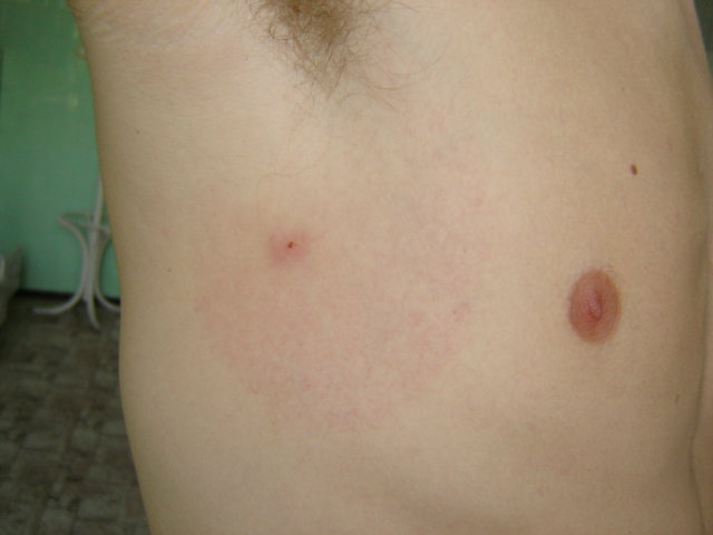 bőrkiütés piros foltok formájában a hát alsó részén skarlát és pikkelysömör kezelése